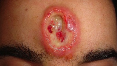 Проявления сифилиса во рту и на лице